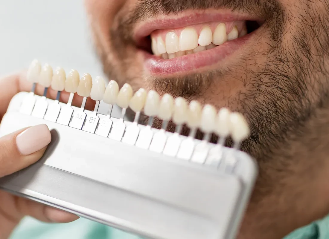 Teeth Whitening at Torrance Dental Spa