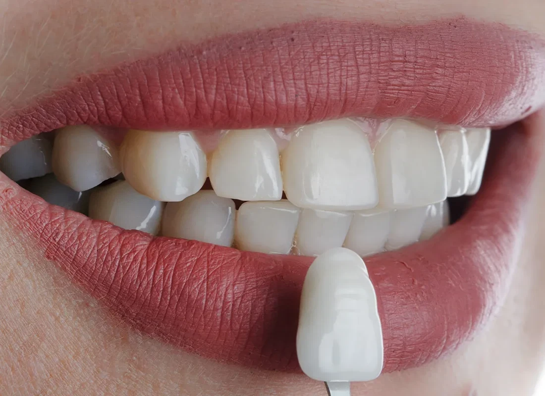 Porcelain Veneers at Torrance Dental Spa