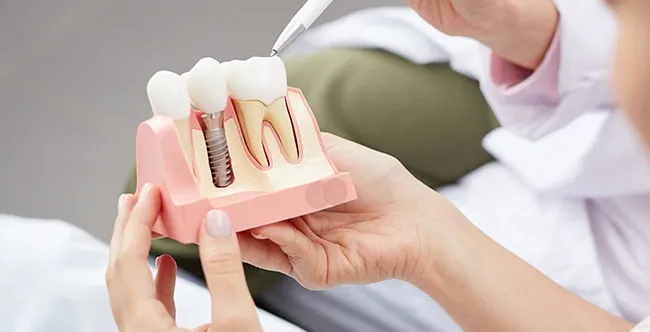 Dental Implants