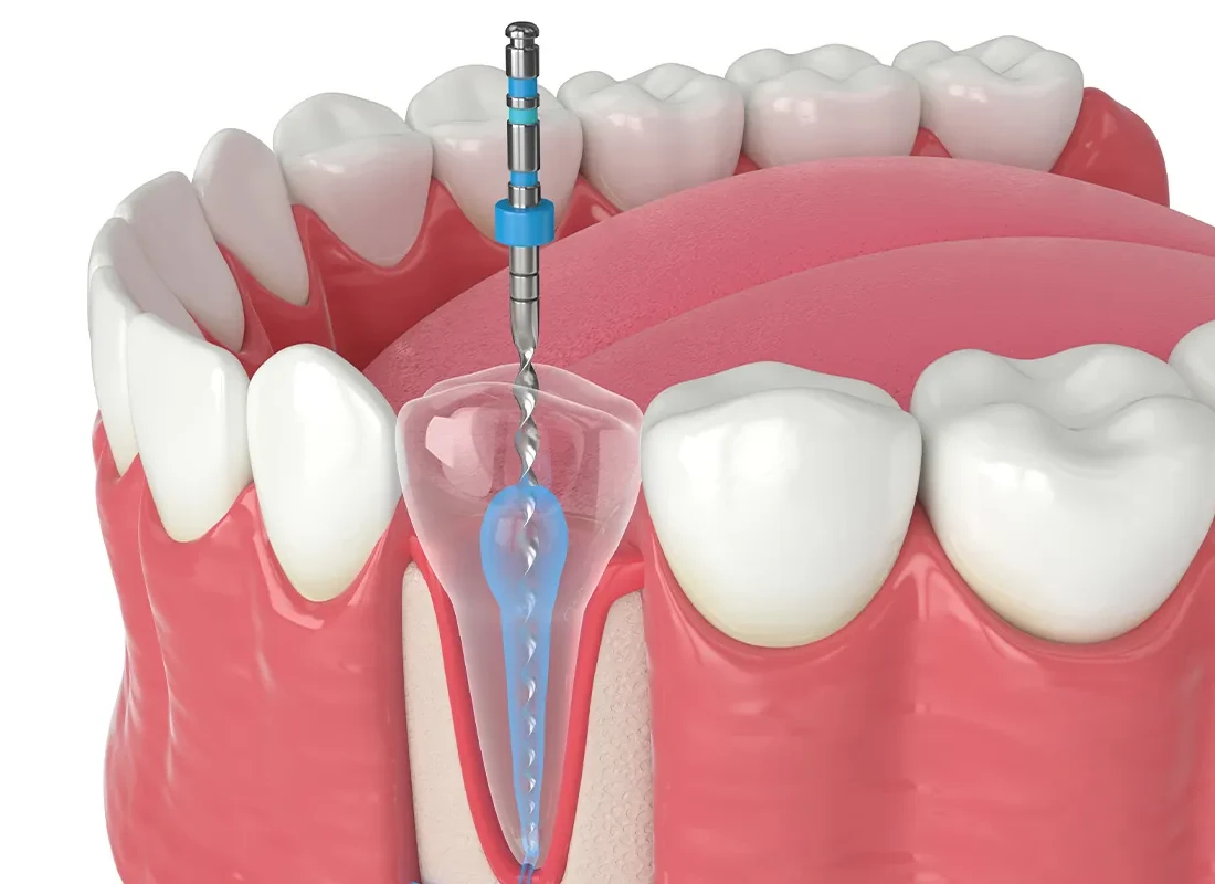 Root Canal Therapy at Torrance Dental Spa