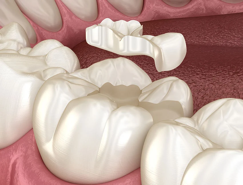 Dental Inlays and onlays or porcelain fillings in Torrance, 90503