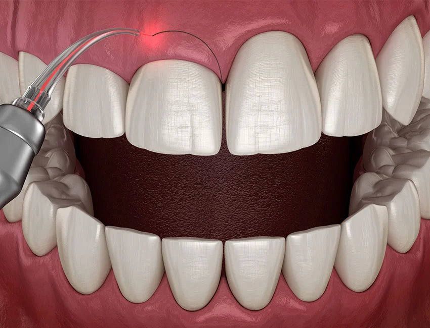 Gum Contouring in Torrance, 90503