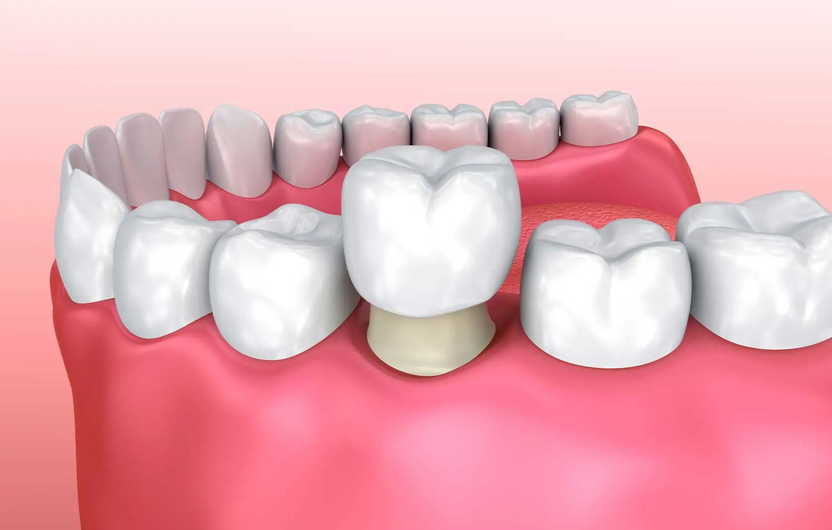 Dental Implants 3D Model