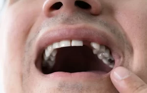 Patient with missing teeth